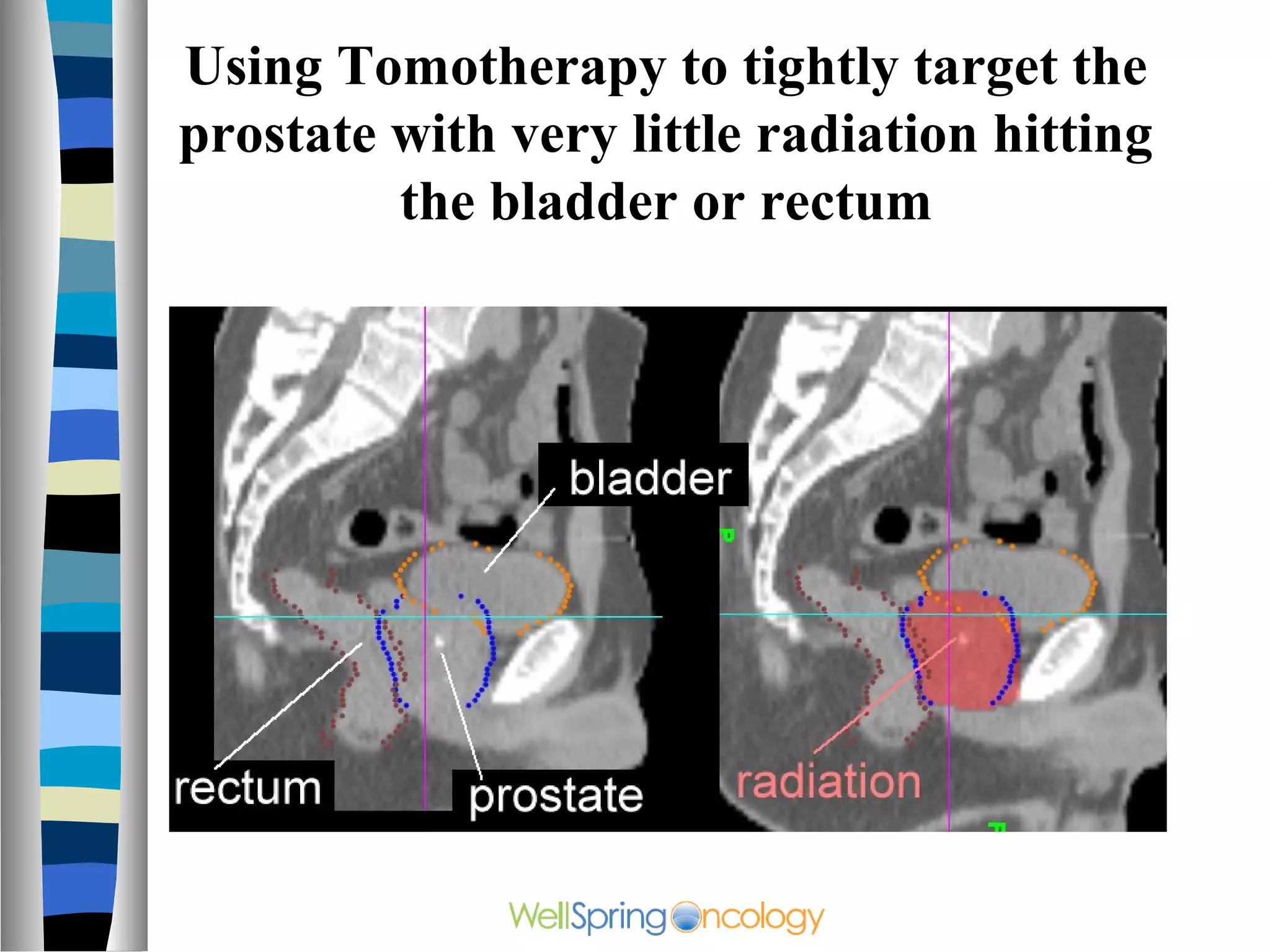 Using Tomotherapy to tightly target the
prostate with very little radiation hitting
         the bladder or rectum
 