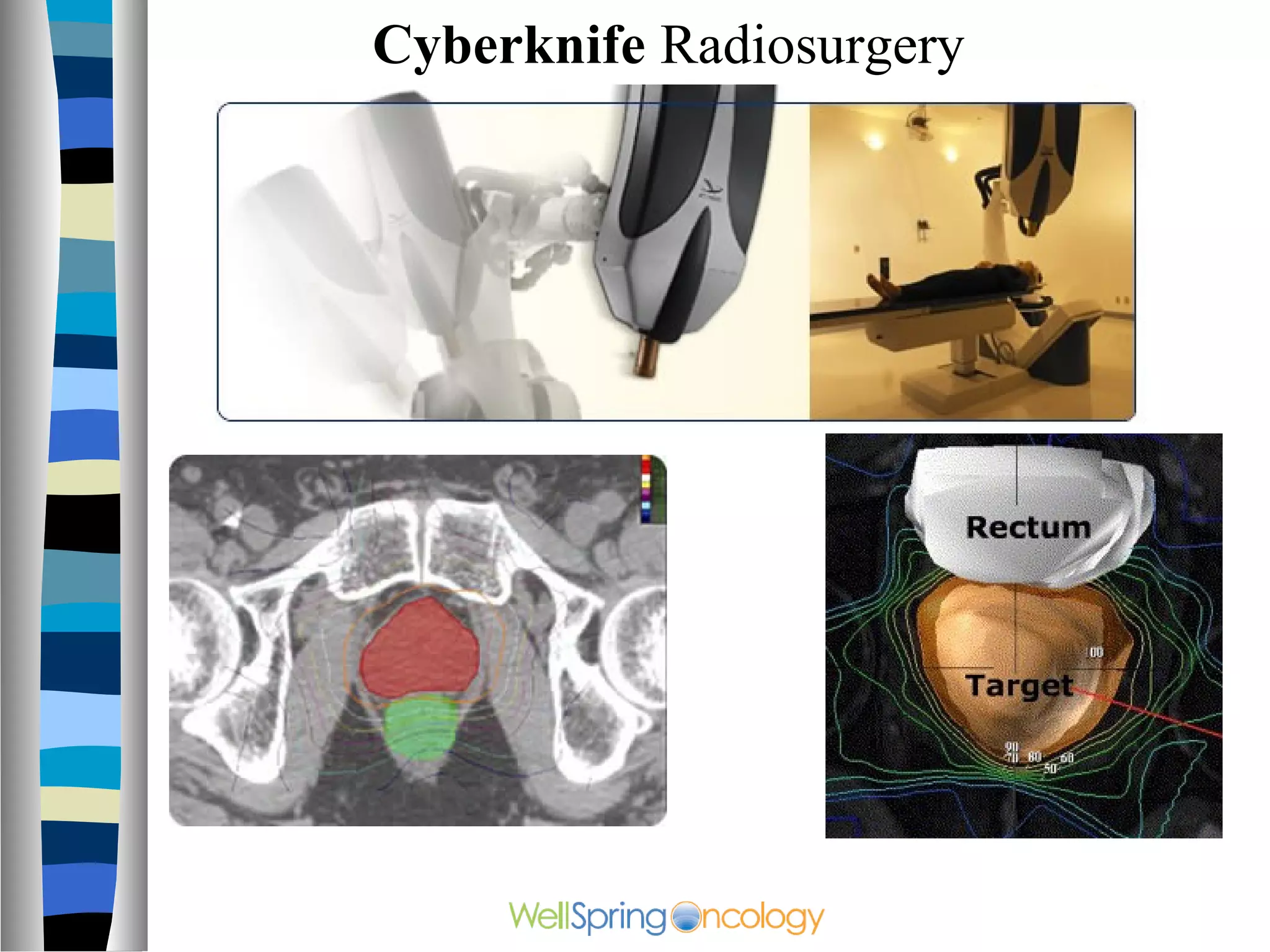 Cyberknife Radiosurgery
 
