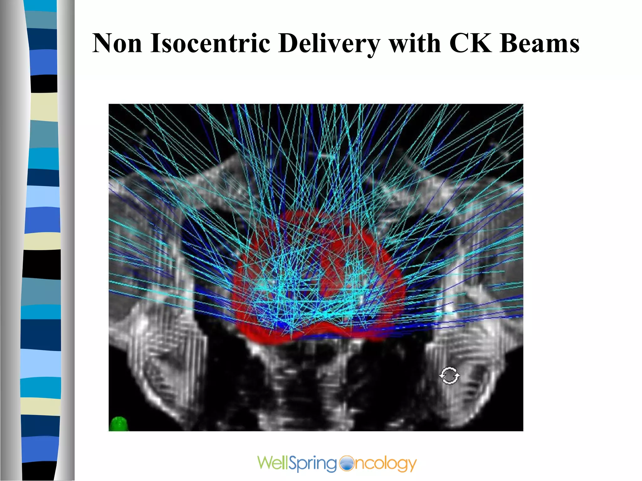Non Isocentric Delivery with CK Beams
 