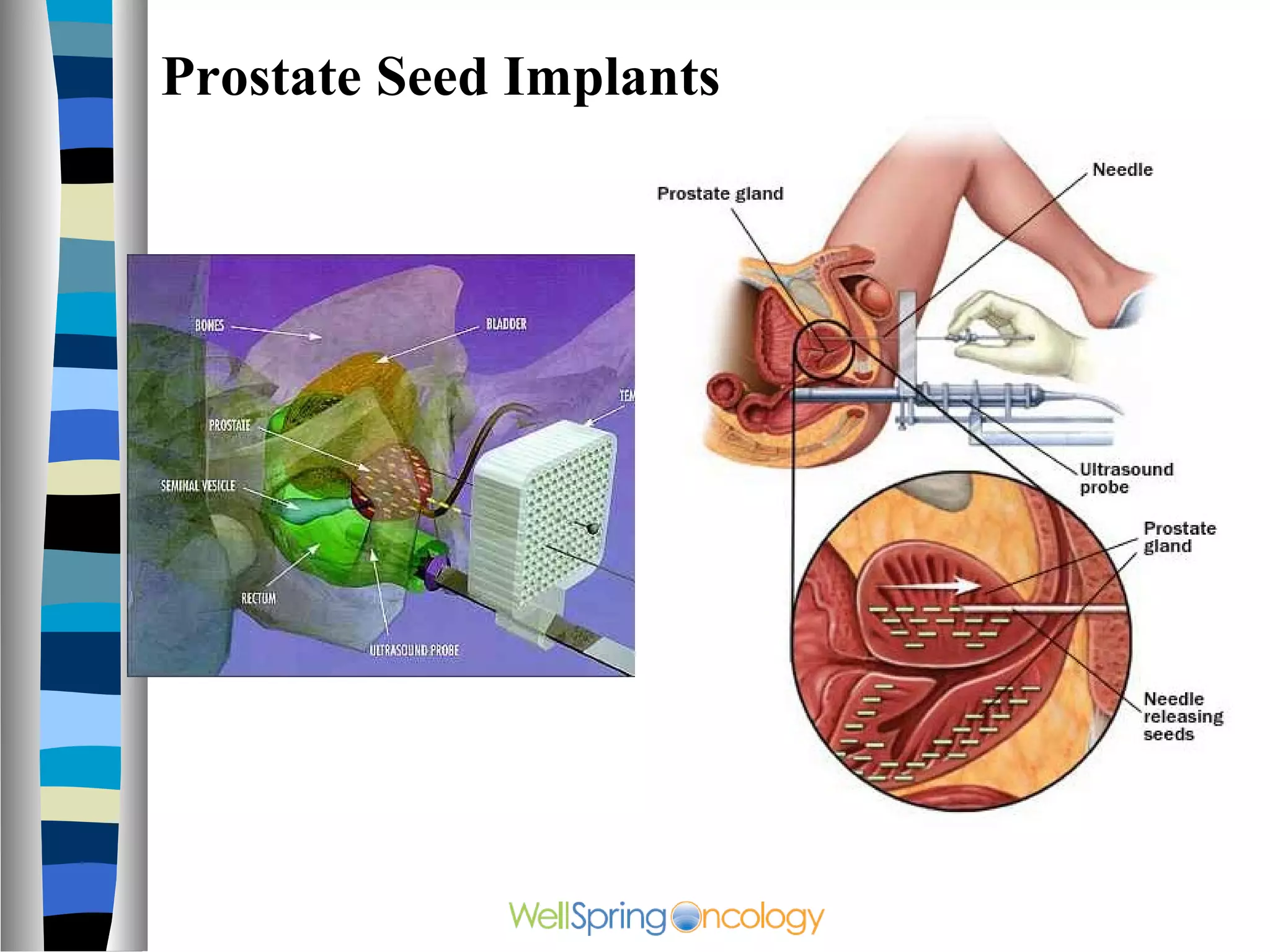 Prostate Seed Implants
 