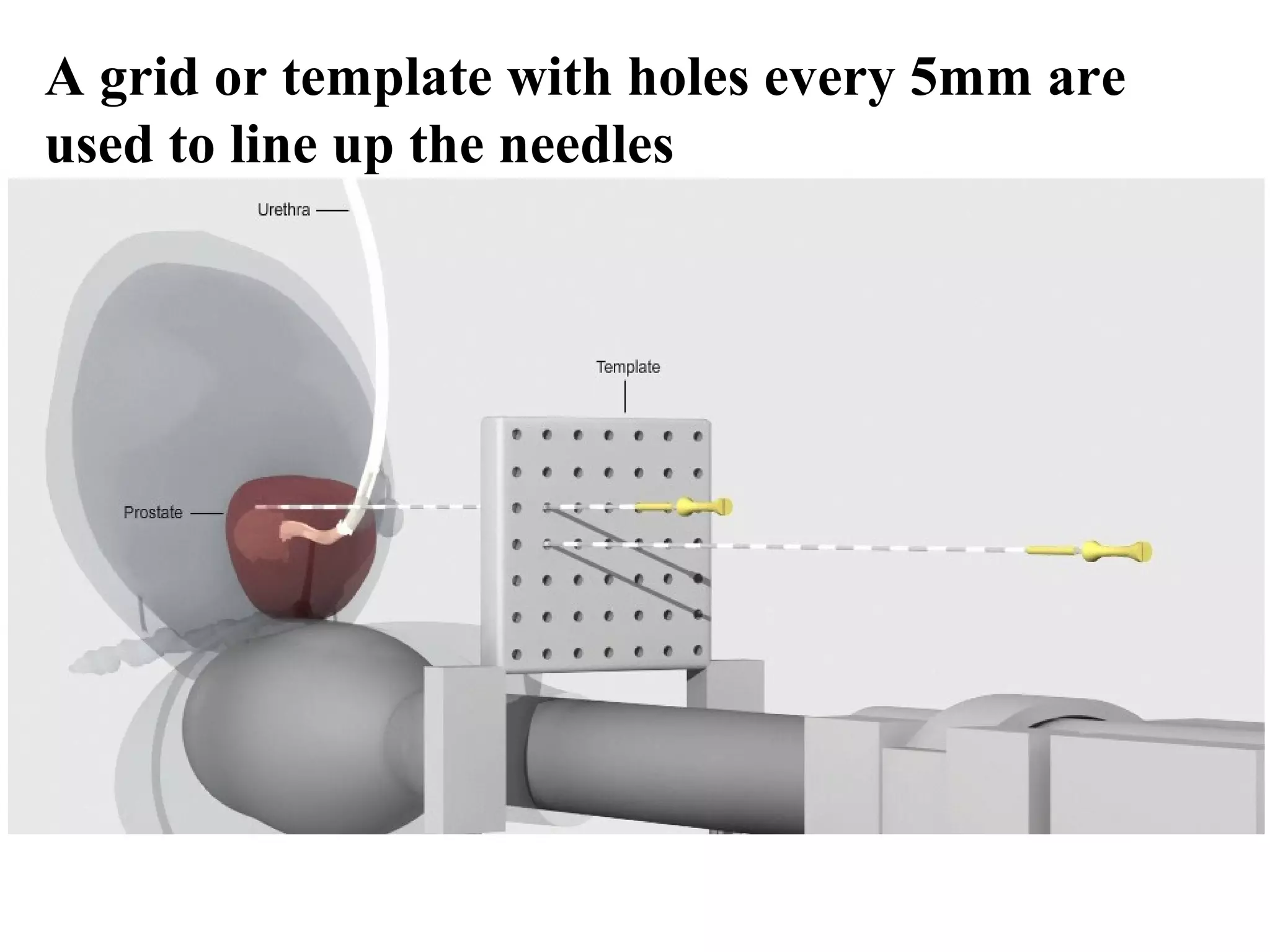 A grid or template with holes every 5mm are
used to line up the needles
 