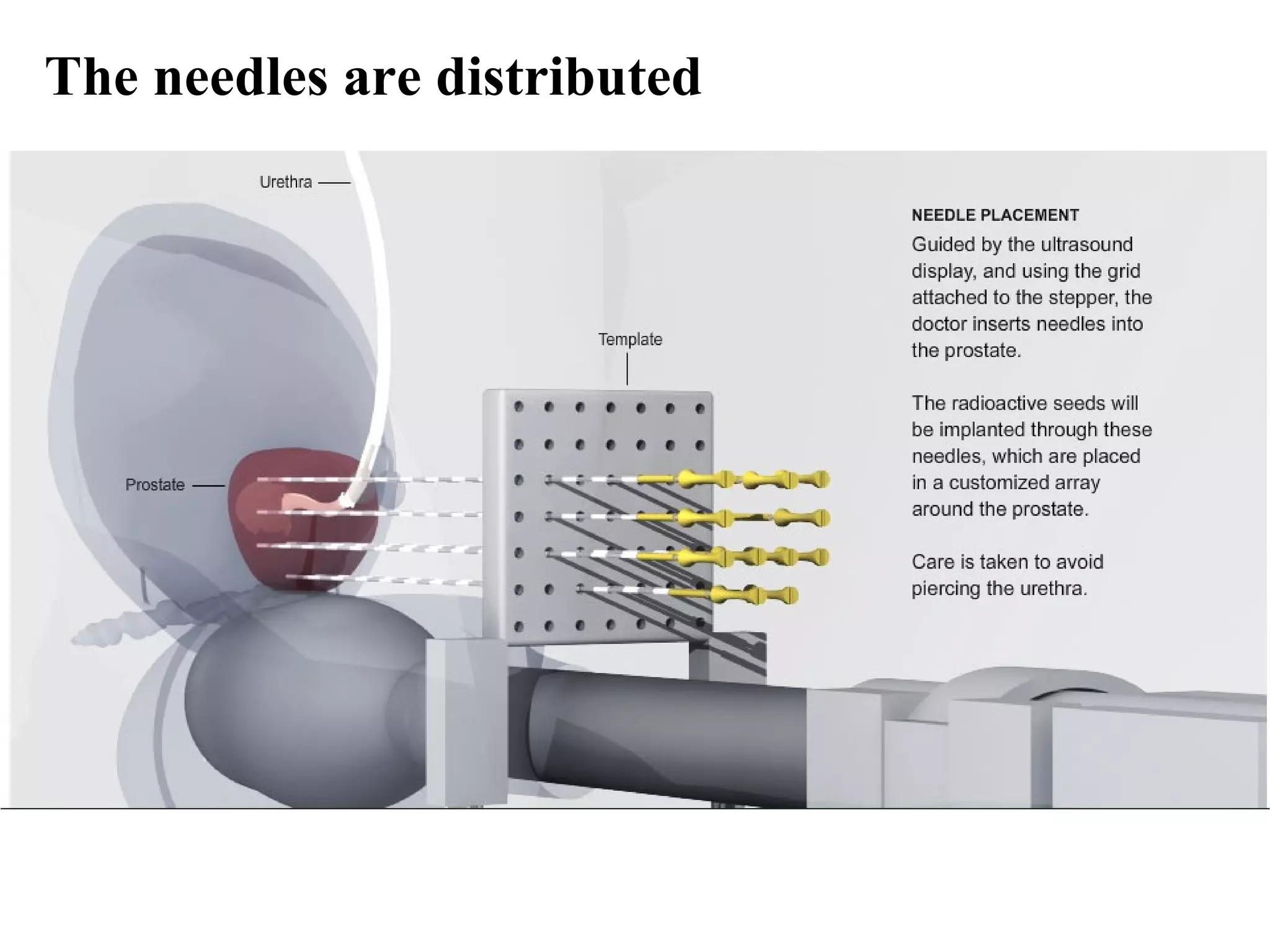 The needles are distributed
 