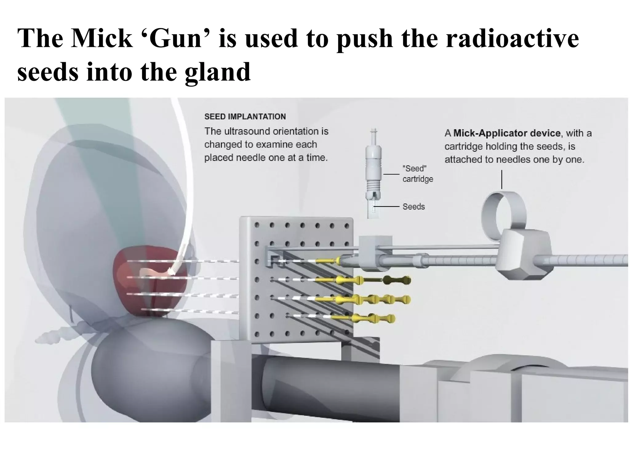 The Mick ‘Gun’ is used to push the radioactive
seeds into the gland
 
