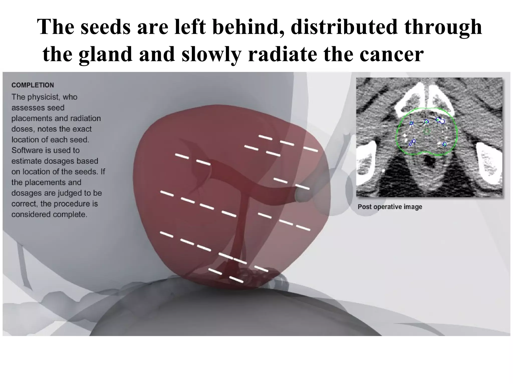 The seeds are left behind, distributed through
the gland and slowly radiate the cancer
 