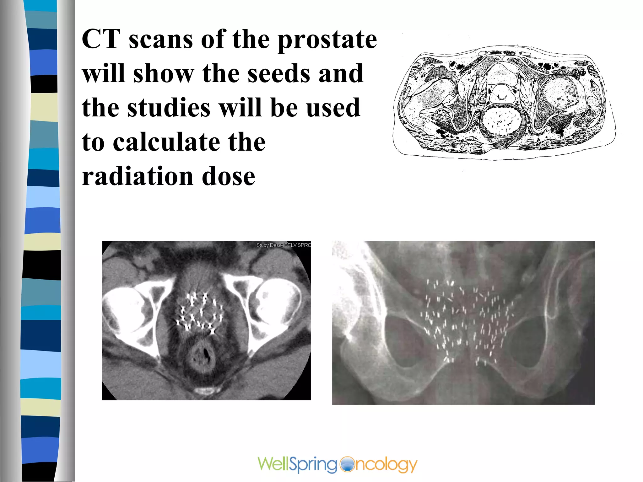 CT scans of the prostate
will show the seeds and
the studies will be used
to calculate the
radiation dose
 