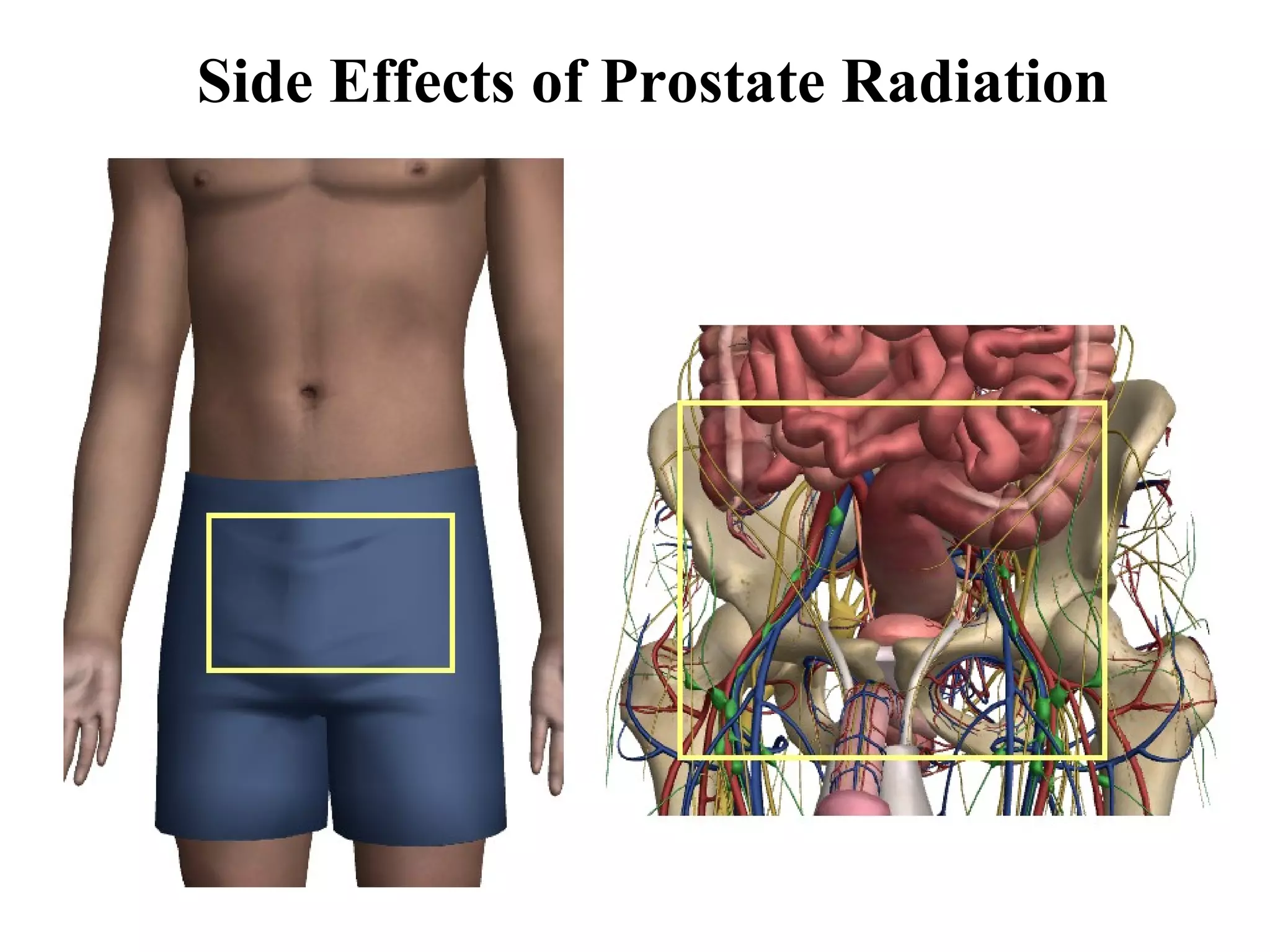 Side Effects of Prostate Radiation
 