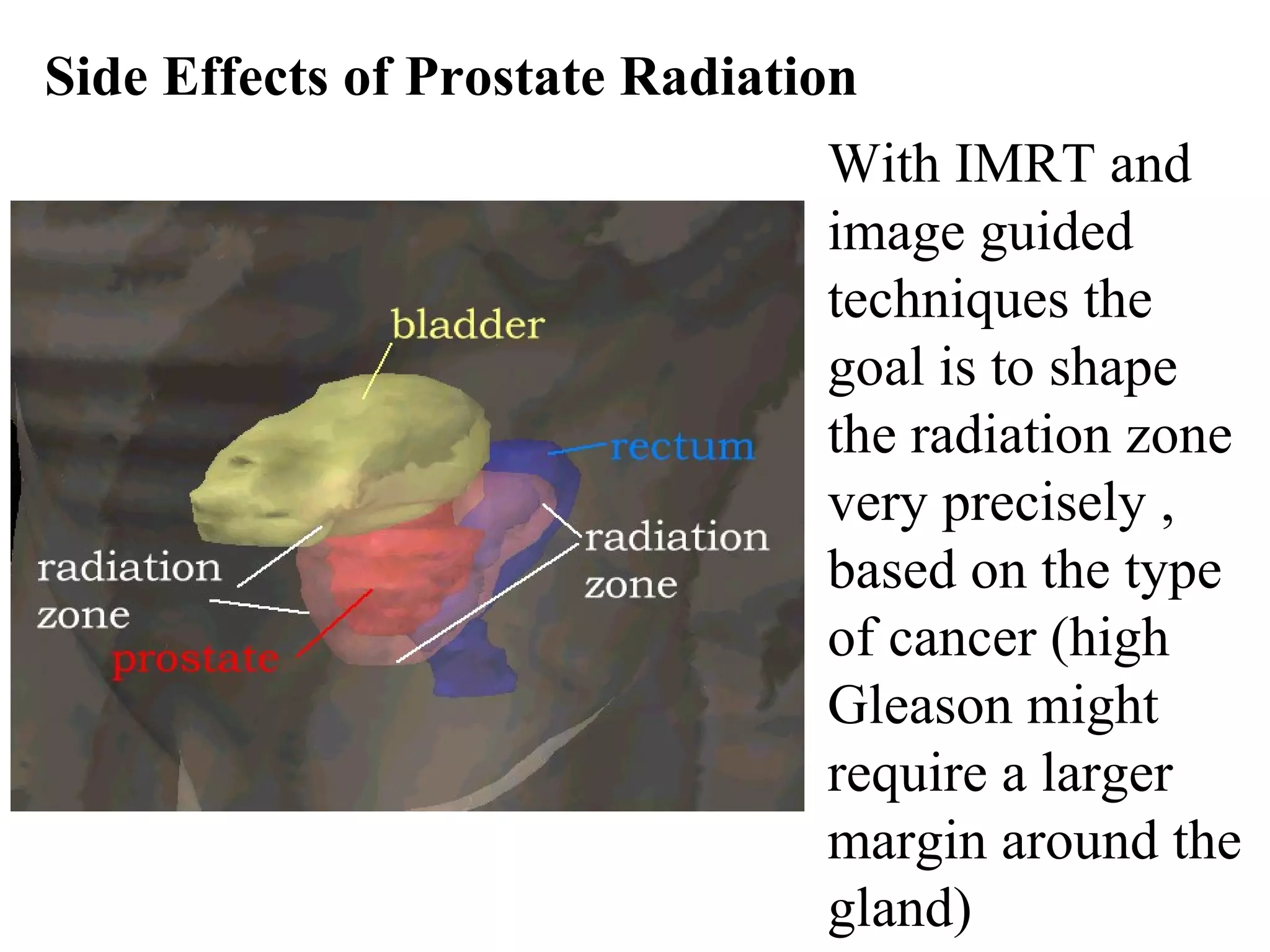 Side Effects of Prostate Radiation
                                With IMRT and
                                image guided
                                techniques the
                                goal is to shape
                                the radiation zone
                                very precisely ,
                                based on the type
                                of cancer (high
                                Gleason might
                                require a larger
                                margin around the
                                gland)
 