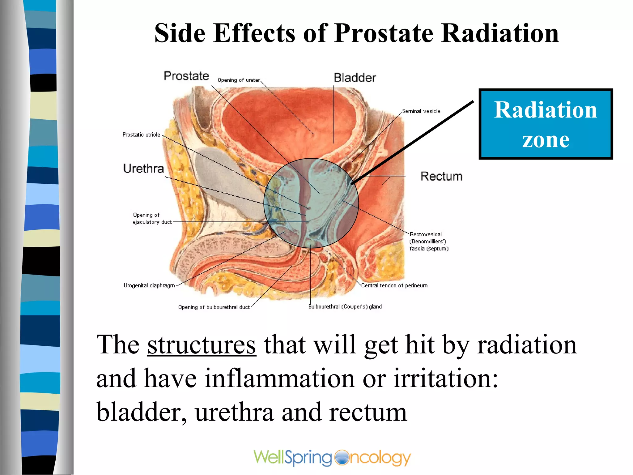 Side Effects of Prostate Radiation

                                     Radiation
                                       zone




The structures that will get hit by radiation
and have inflammation or irritation:
bladder, urethra and rectum
 