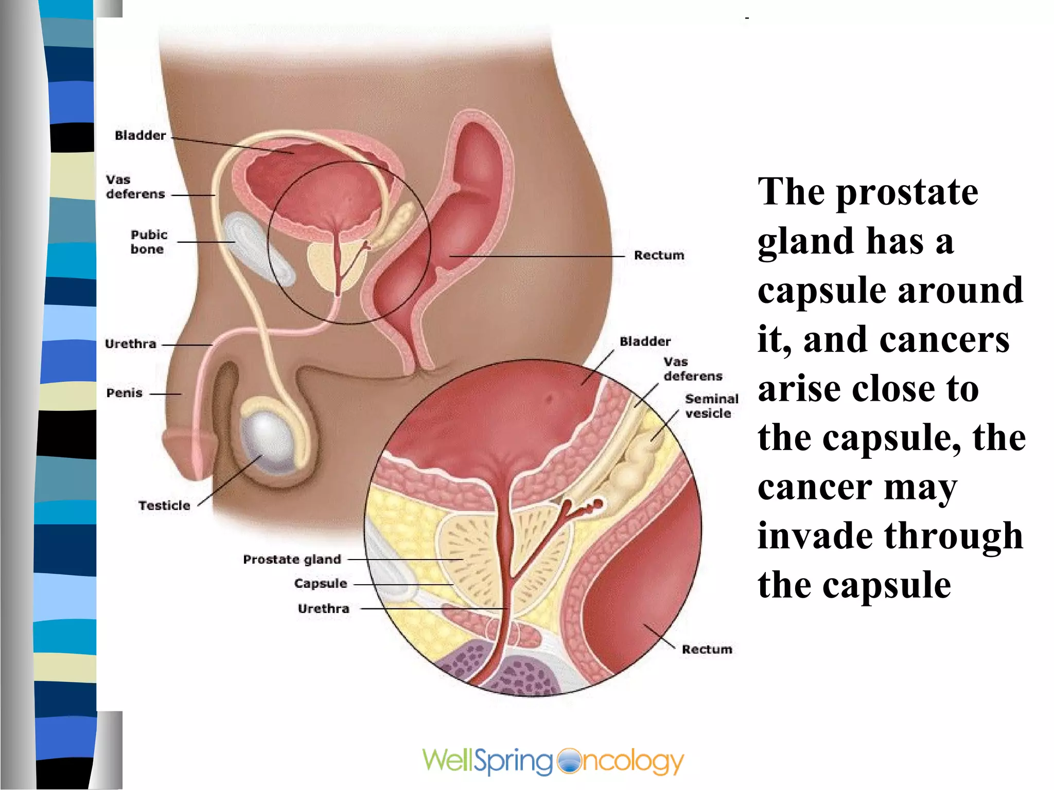 The prostate
gland has a
capsule around
it, and cancers
arise close to
the capsule, the
cancer may
invade through
the capsule
 