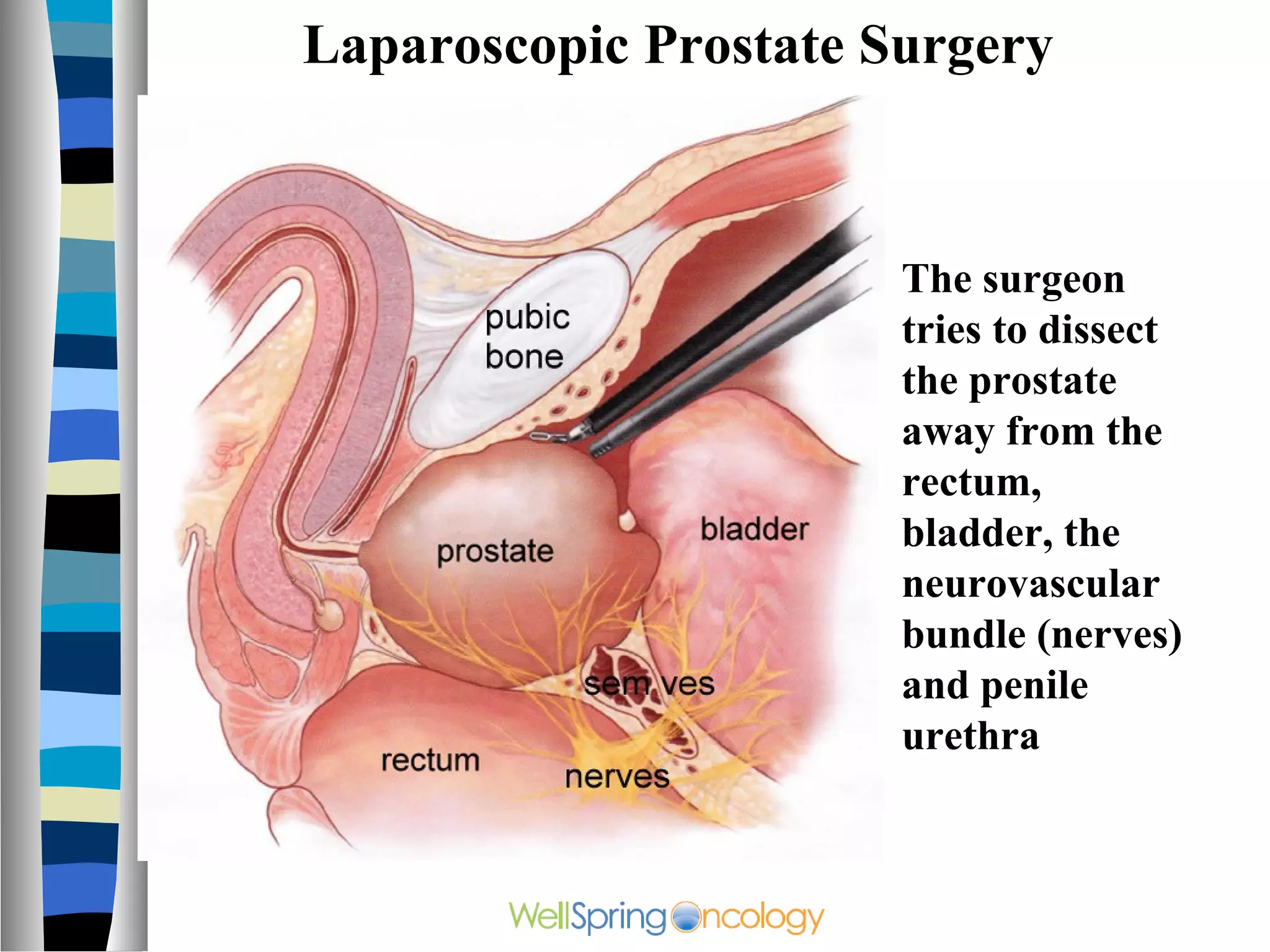 Laparoscopic Prostate Surgery



                       The surgeon
                       tries to dissect
                       the prostate
                       away from the
                       rectum,
                       bladder, the
                       neurovascular
                       bundle (nerves)
                       and penile
                       urethra
 