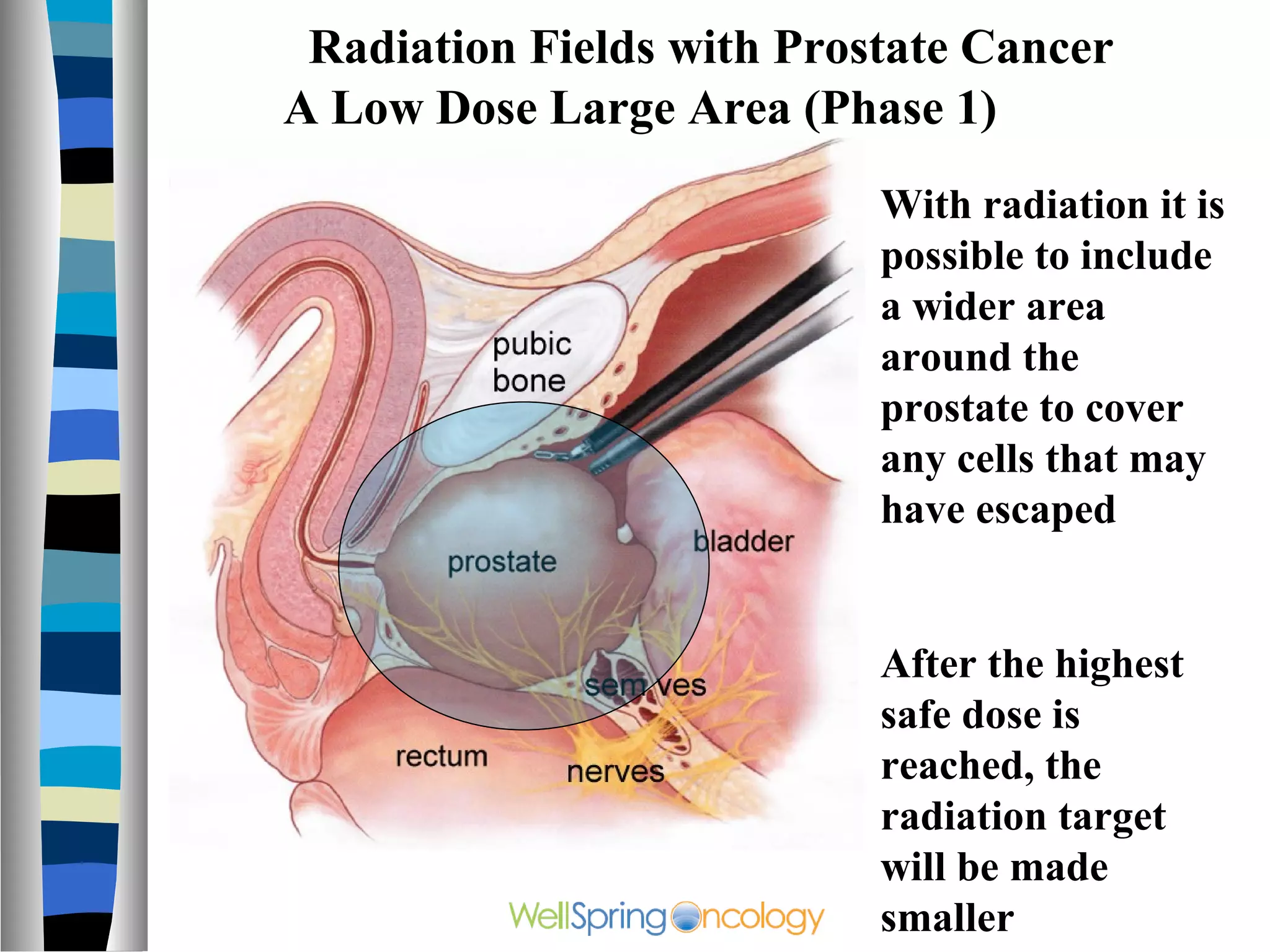 Radiation Fields with Prostate Cancer
A Low Dose Large Area (Phase 1)
                           With radiation it is
                           possible to include
                           a wider area
                           around the
                           prostate to cover
                           any cells that may
                           have escaped


                           After the highest
                           safe dose is
                           reached, the
                           radiation target
                           will be made
                           smaller
 