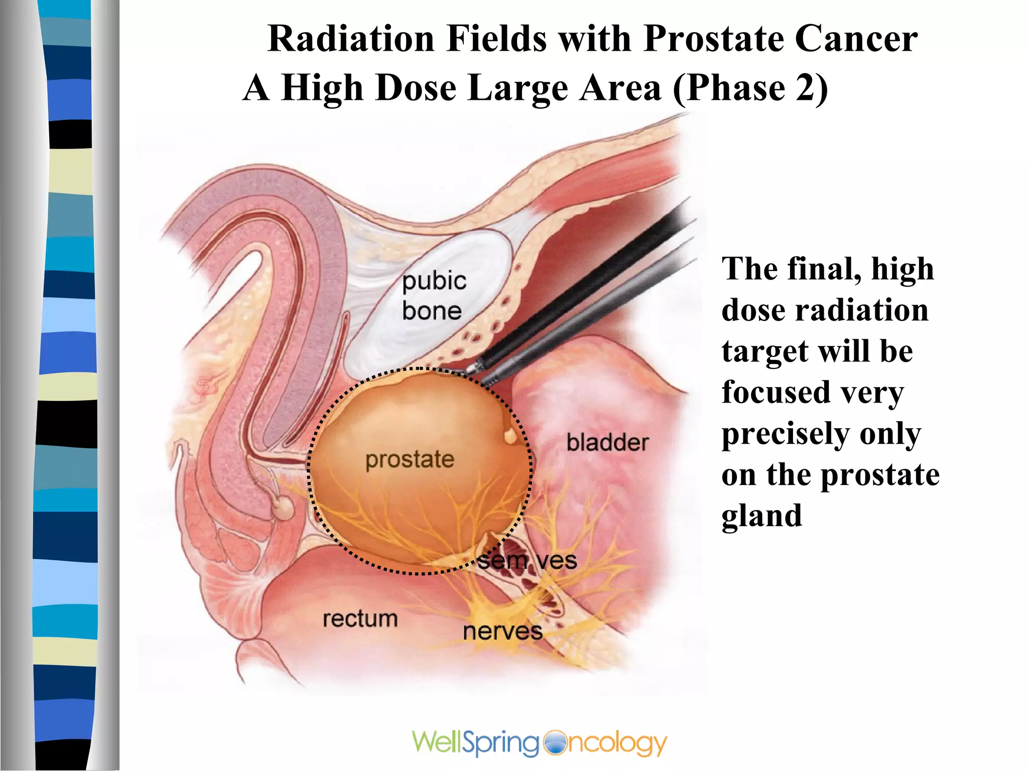 Radiation Fields with Prostate Cancer
A High Dose Large Area (Phase 2)



                          The final, high
                          dose radiation
                          target will be
                          focused very
                          precisely only
                          on the prostate
                          gland
 