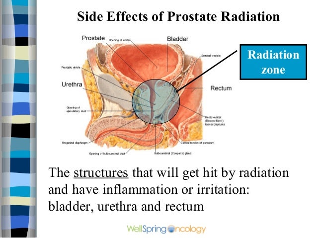 long term side effects of lupron for prostate cancer