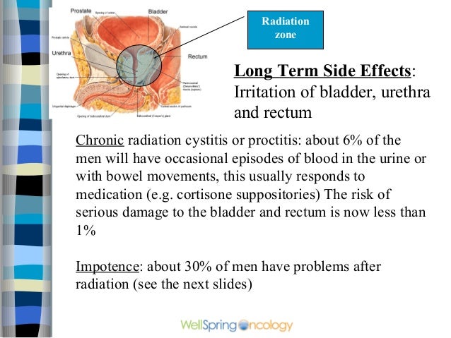 Effects Of Radiation Therapy For Prostate Cancer