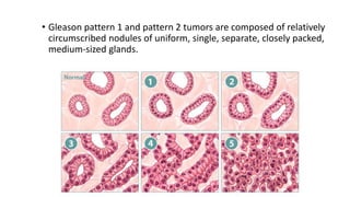 • Gleason pattern 1 and pattern 2 tumors are composed of relatively
circumscribed nodules of uniform, single, separate, closely packed,
medium-sized glands.
 