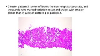 • Gleason pattern 3 tumor infiltrates the non-neoplastic prostate, and
the glands have marked variation in size and shape, with smaller
glands than in Gleason pattern 1 or pattern 2.
 