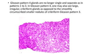 • Gleason pattern 4 glands are no longer single and separate as in
patterns 1 to 3. In Gleason pattern 4, one may also see large,
irregular, cribriform glands as opposed to the smoothly
circumscribed smaller nodules of cribriform Gleason pattern 3.
 