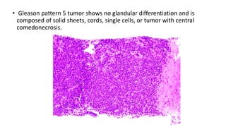 • Gleason pattern 5 tumor shows no glandular differentiation and is
composed of solid sheets, cords, single cells, or tumor with central
comedonecrosis.
 