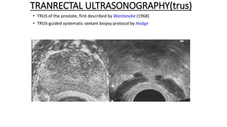 TRANRECTAL ULTRASONOGRAPHY(trus)
• TRUS of the prostate, first described by Wantanabe (1968)
• TRUS-guided systematic sextant biopsy protocol by Hodge
 