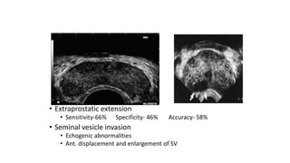 • Extraprostatic extension
• Sensitivity-66% Specificity- 46% Accuracy- 58%
• Seminal vesicle invasion
• Echogenic abnormalities
• Ant. displacement and enlargement of SV
 