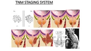 TNM STAGING SYSTEM
 