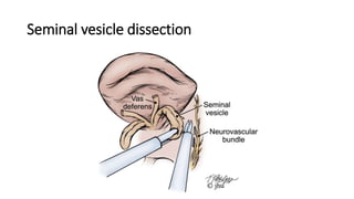 Seminal vesicle dissection
 