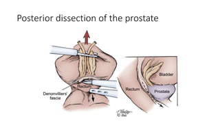 Posterior dissection of the prostate
 
