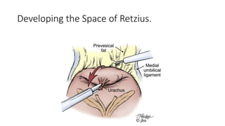 Developing the Space of Retzius.
 