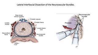 Lateral Interfascial Dissection of the Neurovascular Bundles.
 