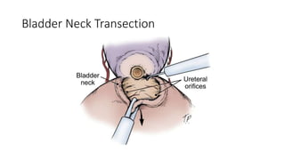 Bladder Neck Transection
 
