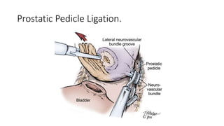 Prostatic Pedicle Ligation.
 