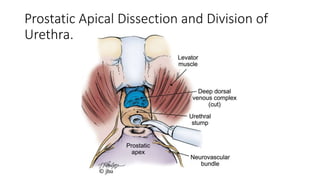Prostatic Apical Dissection and Division of
Urethra.
 