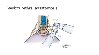Vesicourethral anastomosis
 