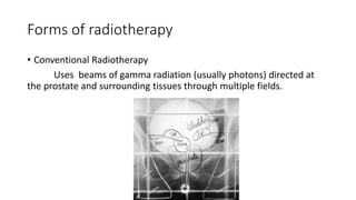 Forms of radiotherapy
• Conventional Radiotherapy
Uses beams of gamma radiation (usually photons) directed at
the prostate and surrounding tissues through multiple fields.
 
