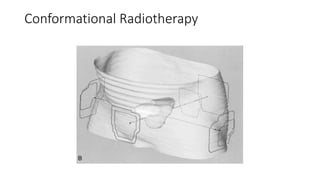 Conformational Radiotherapy
 