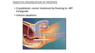 TARGETED CRYOABLATION OF PROSTATE
• Cryoablation: cancer treatment by freezing to -40º
Centigrade
• Induces apoptosis
 