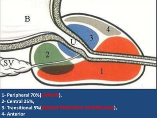 1- Peripheral 70%(CANCER),
2- Central 25%,
3- Transitional 5%(BENIGN PROSTATIC HYPERPLASIA),
4- Anterior
 