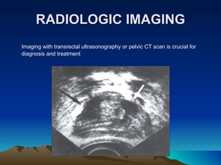 RADIOLOGIC IMAGING Imaging with transrectal ultrasonography or pelvic CT scan is crucial for diagnosis and treatment 