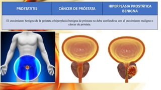 PROSTATITIS CÁNCER DE PRÓSTATA
HIPERPLASIA PROSTÁTICA
BENIGNA
El crecimiento benigno de la próstata o hiperplasia benigna de próstata no debe confundirse con el crecimiento maligno o
cáncer de próstata.
 