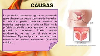 La prostatitis bacteriana aguda es provocada
generalmente por cepas comunes de bacterias.
la infección puede comenzar cuando las
bacterias presentes en la orina se filtran en la
próstata prostatitis puede aparecer de manera
gradual o repentina. Puede mejorar
rápidamente, ya sea por sí sola o con
tratamiento. Algunos tipos de prostatitis duran
meses o se vuelven recurrentes (prostatitis
crónica).
 