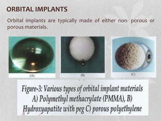 ORBITAL IMPLANTS
Orbital implants are typically made of either non- porous or
porous materials.
 