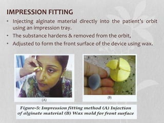 IMPRESSION FITTING
• Injecting alginate material directly into the patient’s orbit
using an impression tray.
• The substance hardens & removed from the orbit,
• Adjusted to form the front surface of the device using wax.
 