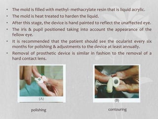 • The mold is filled with methyl- methacrylate resin that is liquid acrylic.
• The mold is heat treated to harden the liquid.
• After this stage, the device is hand painted to reflect the unaffected eye.
• The iris & pupil positioned taking into account the appearance of the
fellow eye.
• It is recommended that the patient should see the ocularist every six
months for polishing & adjustments to the device at least annually.
• Removal of prosthetic device is similar in fashion to the removal of a
hard contact lens.
polishing contouring
 