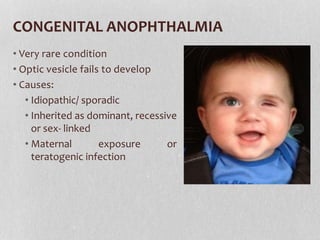 CONGENITAL ANOPHTHALMIA
• Very rare condition
• Optic vesicle fails to develop
• Causes:
• Idiopathic/ sporadic
• Inherited as dominant, recessive
or sex- linked
• Maternal exposure or
teratogenic infection
 