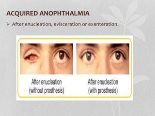 ACQUIRED ANOPHTHALMIA
 After enucleation, evisceration or exenteration.
 