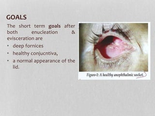 GOALS
The short term goals after
both enucleation &
evisceration are
• deep fornices
• healthy conjucntiva,
• a normal appearance of the
lid.
 