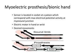 Myoelectric prosthesis/bionic hand
• Sensor is located in socket at a palace which
correspond with max electrical potential activity at
myoneural junction
• Electric motor in hand or wrist
• Desired movements
 