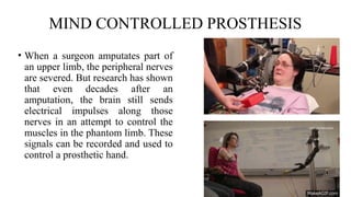 PROSTHESIS - PHYSIOTHERAPY REHABILITATION | PPTX
