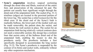 Symes Socket PROSTHESIS - PHYSIOTHERAPY REHABILITATION | PPTX
