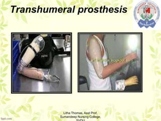 Transhumeral prosthesis
Litha Thomas, Asst Prof,
Sumandeep Nursing College,
 